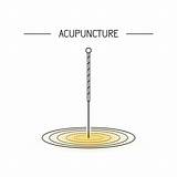 Acupuncture Need Know Needle Scheduling Treatment Before Things First sketch template