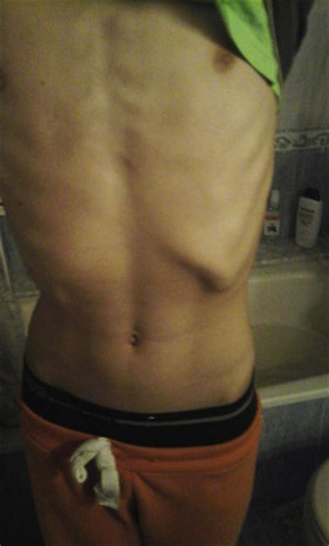 abdominal pain  chest wall deformity   teen athlete