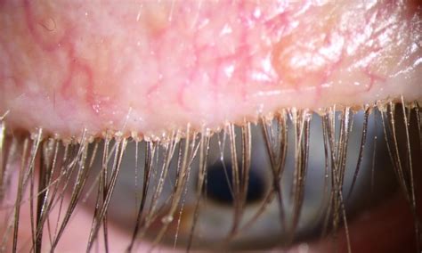 images eye mites  humans treatment demodectic mange