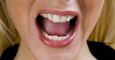 lengua ardiente sindrome de boca ardiente causas  remedios caseros salud tudo