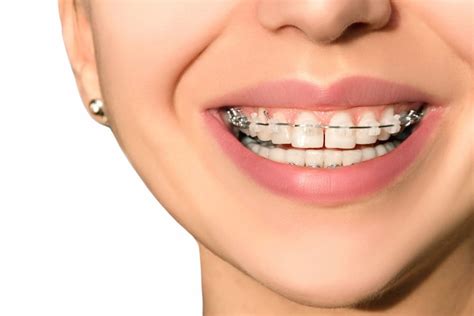 ceramic braces  metal braces nikaeen orthoodontic