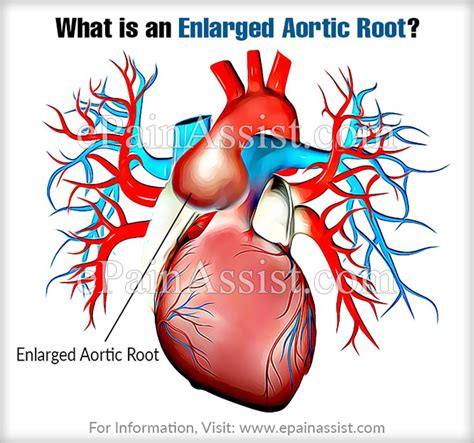 enlarged aortic root