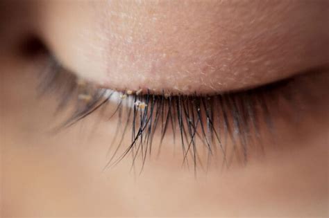 eyelash mites signs   treatments myvisionorg