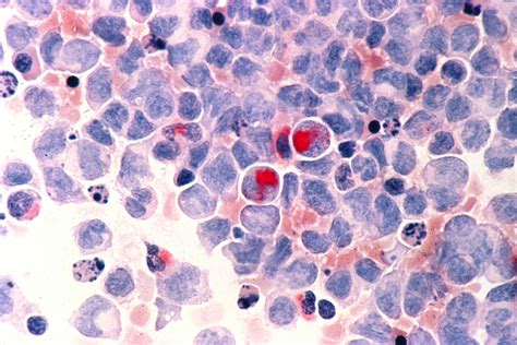 fileleukemia amljpg