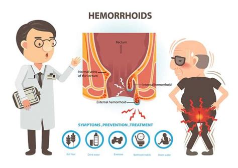 hemorrhoids symptoms causes diagnosis treatment
