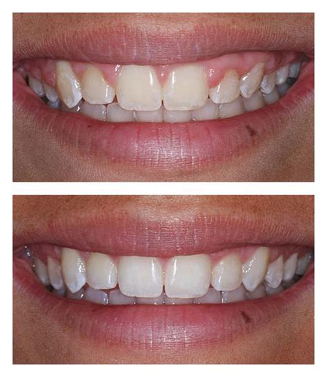 Cosmetic Gum Lift Before And After Bartholomew Dentist