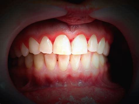 swollen gums   home remedies    symptoms
