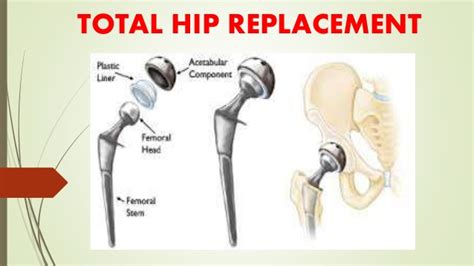 Total Hip Replacement Is The Solution For The Damaged Hip