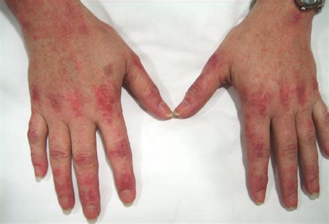 Inflammatory And Immune Myopathies