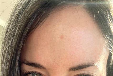 slightly raised spot  forehead rdermatologyquestions