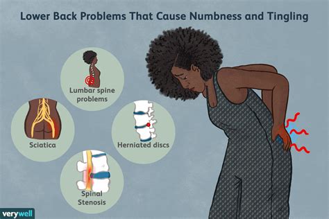 Symptoms Of Numbness And Tingling In Lower Back