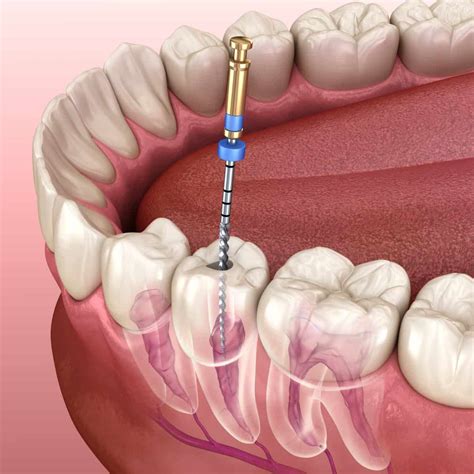 root canal therapy carolina dental arts