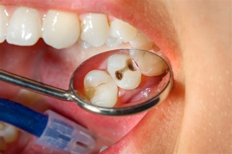 dealing  cavities tennessee river dental