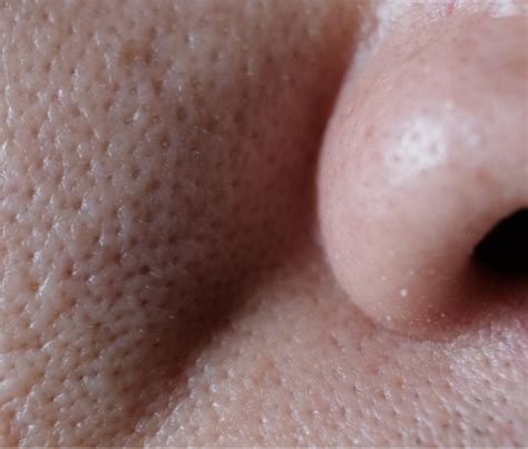 enlarged  open pores  ogee clinic