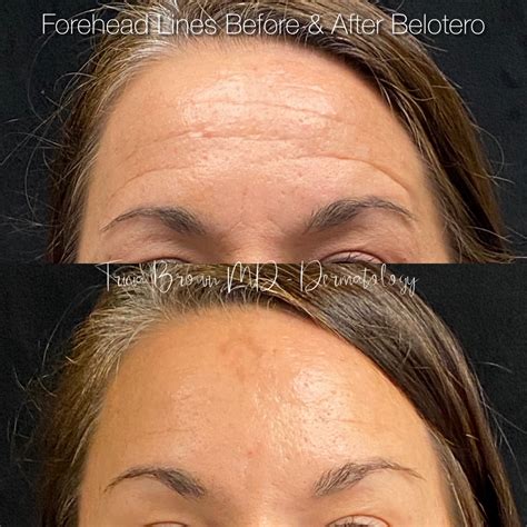 forehead  filler houston tx dermatologist