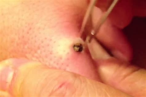 blackhead removed after 25 years daily star