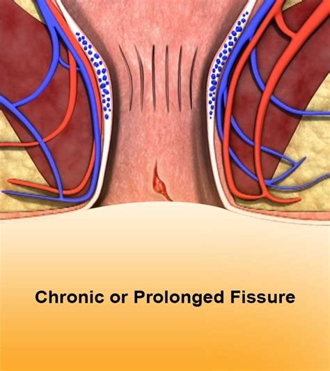 anal fissure surgery what are the symptoms causes and treatments