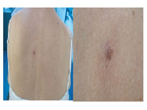 analytic dermoscopy  superficial basal cell carcinoma journal  case reports  medicine
