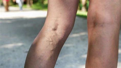 Varicose Vein Fix How To Glue Leaky Leg Valves