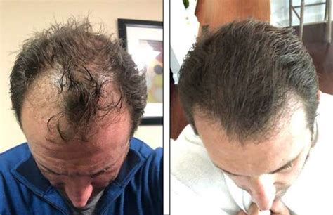 Atlanta Hair Transplant Fue Hair Transplants