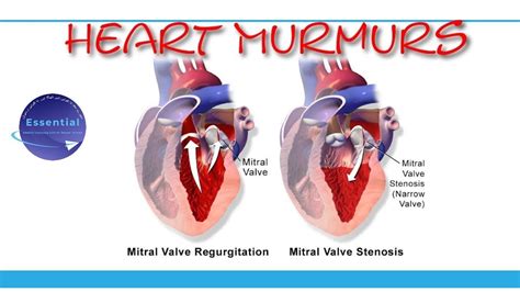 2 heart valve murmurs mnemonic for murmurs in just 5 minutes usmle