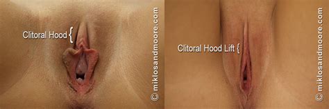 clitoral unhooding before and after