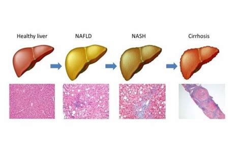 liver nk cells in non alocholic fatty liver disease institute of
