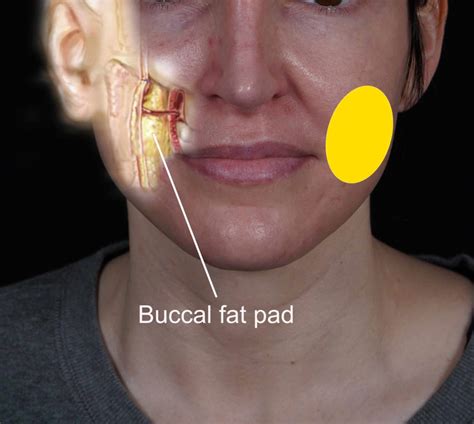 buccal fat removal  san diego plastic surgeon dr john hilinski