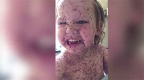 mum s fury after tot s chicken pox pictures used by facebook scammers