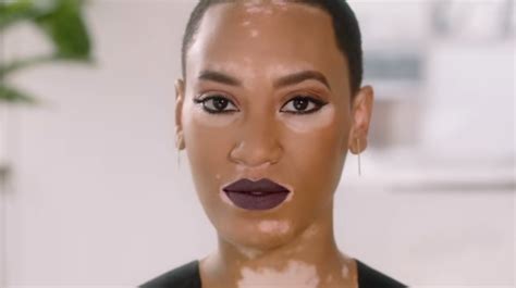 Covergirl Campaign Features Model With Vitiligo For First