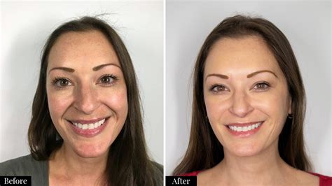 honest review  filler  smile lines  vein center