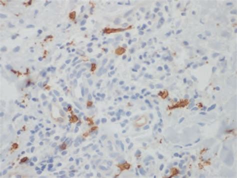 density of mast cells and intensity of pruritus in