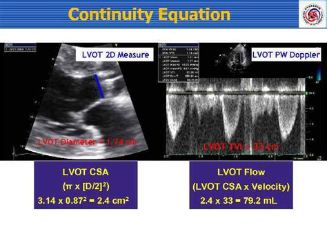 aortic valve disease normal aortic valve parasternal