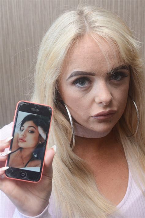 Womans Lips Swelled So Much In Botched Filler Treatment That Her Mum