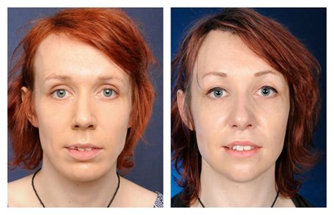 facial feminization surgery before and after picsninja club