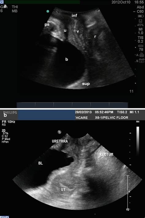 Practical Application Of Ultrasound In The Assessment Of Pelvic Organ
