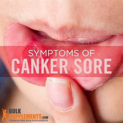 canker sores  bottom lip siteliporg