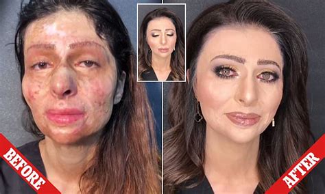 Burn Victim Gets Makeover That Brings Her To Tears Daily Free Nude