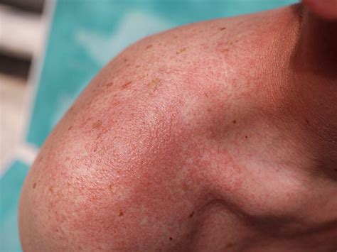 heat rash  symptoms  effective prevention