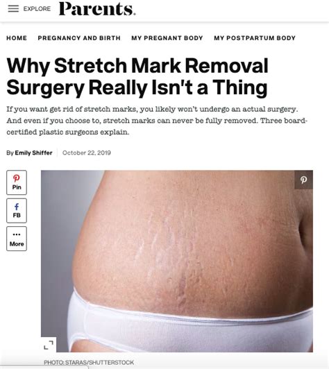 Can You Repair Stretch Marks