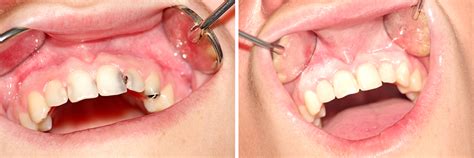 Composite Resin Fillings Tooth Decay Cracked Teeth