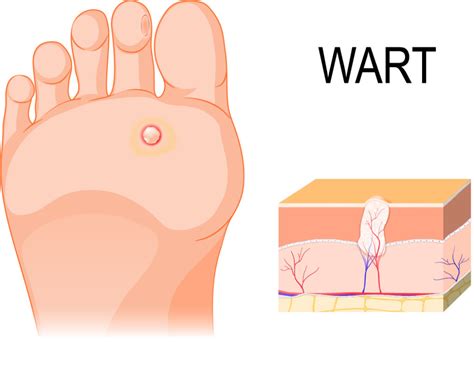 plantar warts — foot and ankle health centers