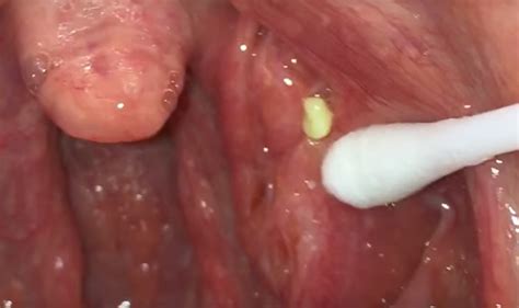 Tonsil Stone Removal Videos Are The New Pimple Popping Videos For All