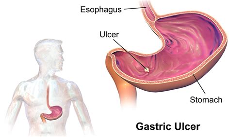 Stomach Ulcer Peptic Ulcer — Symptoms And Treatment Lecturio