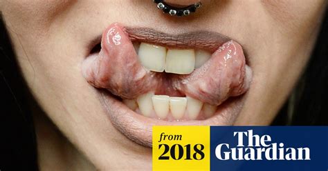Tongue Splitting Poses Serious Risk To Health Say Surgeons Dentists