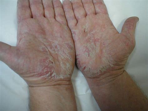 medical pictures info atopic dermatitis