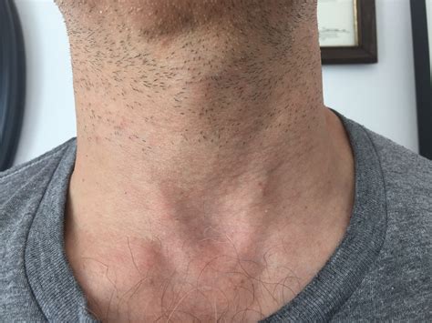 thyroid  surgery  fix  large symptomatic  ugly goiter