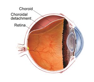 choroidal detachment patients  american society  retina