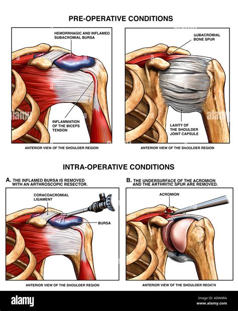 shoulder injury bursitis  ac joint bone spurs  surgery repair
