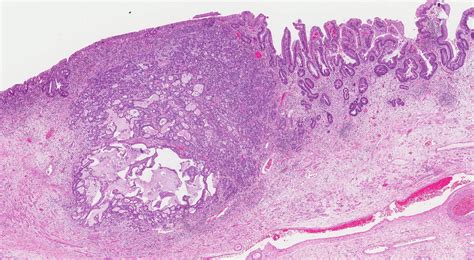 adenocarcinoma   esophagus mypathologyreportca